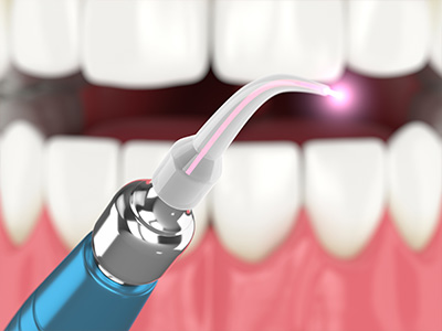 KORsmiles Dental | MLS Laser Therapy, Wisdom Teeth and TMJ Disorders